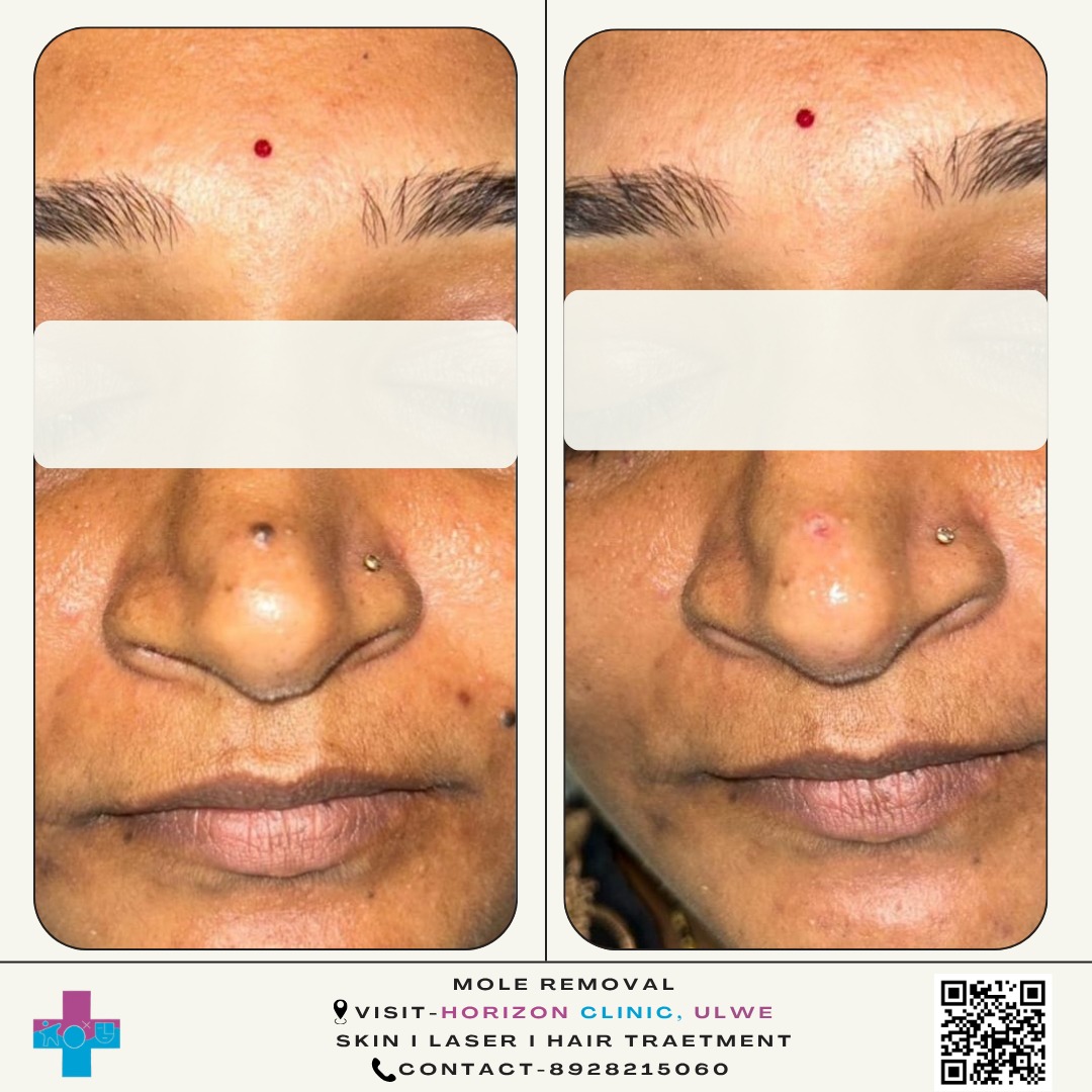 Facial Mole Excision